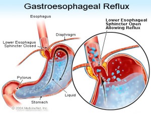 Ce este refluxul acid sau refluxul gastroesofagian?