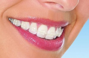 Lucruri pe care trebuie sa le stii atunci cand iti pui un aparat dentar 