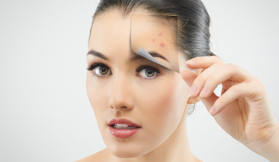 Cum sa scapati usor de acnee ?